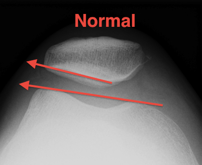 Patella Laurin View Normal